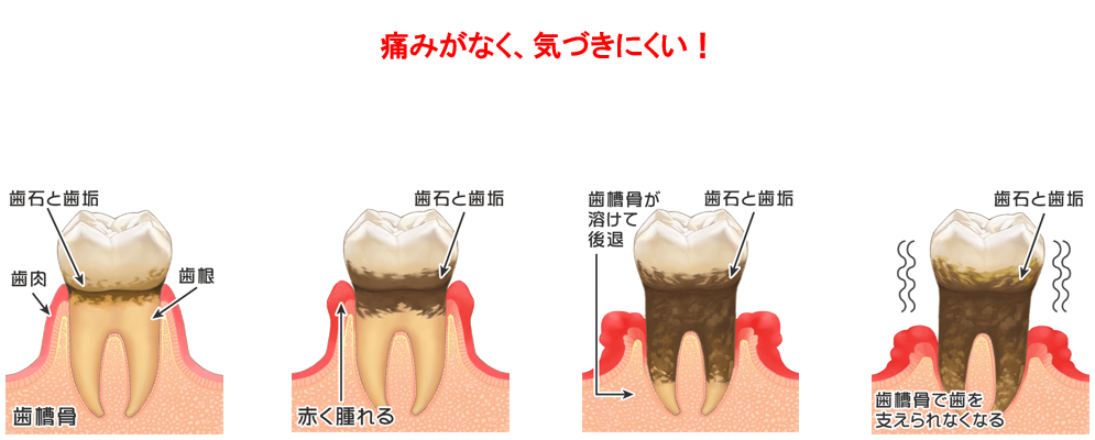 一般歯科：歯周病