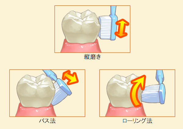 予防歯科：歯磨き指導